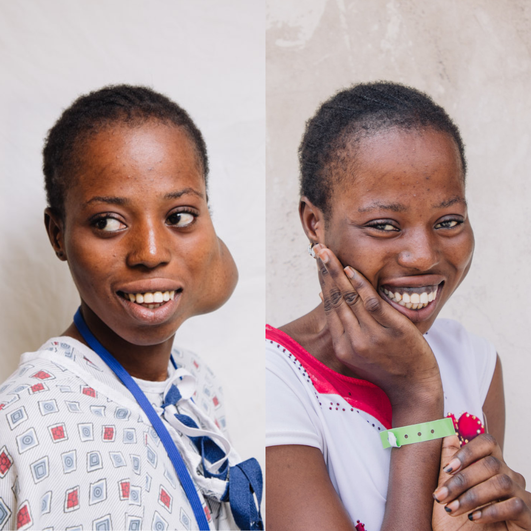 Mercy Ships :Une adolescente dont la tumeur avait été qualifiée « d’inopérable » voit sa vie transformée par une organisation caritative chirurgicale en Afrique