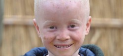 UNICEF MozambiqueSergio Fernandez, Children with albinism are often discriminated against and abused